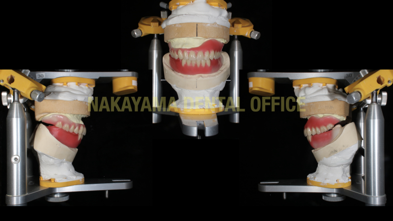 Magnet denture のコピー取り出し.001