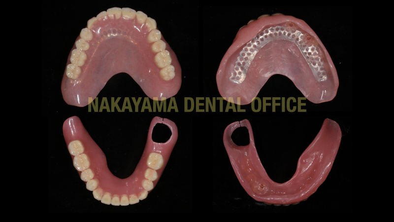 Magnet denture のコピー取り出し.003