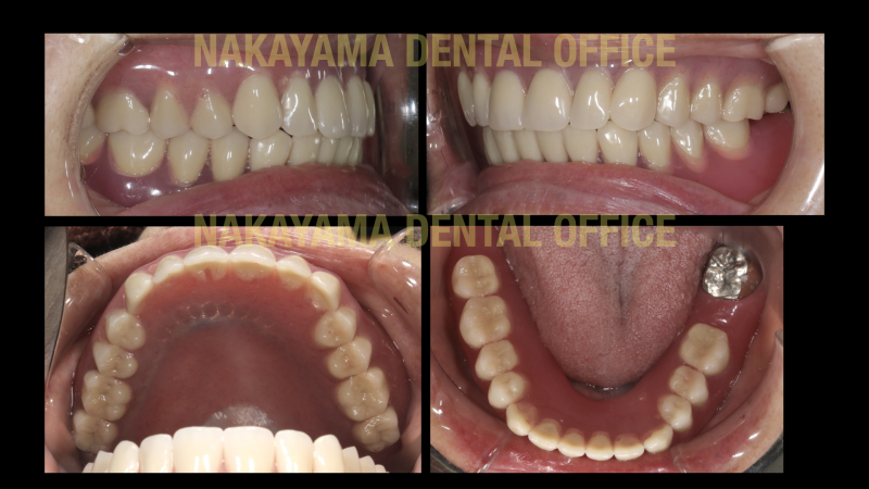 Magnet denture のコピー取り出し.005